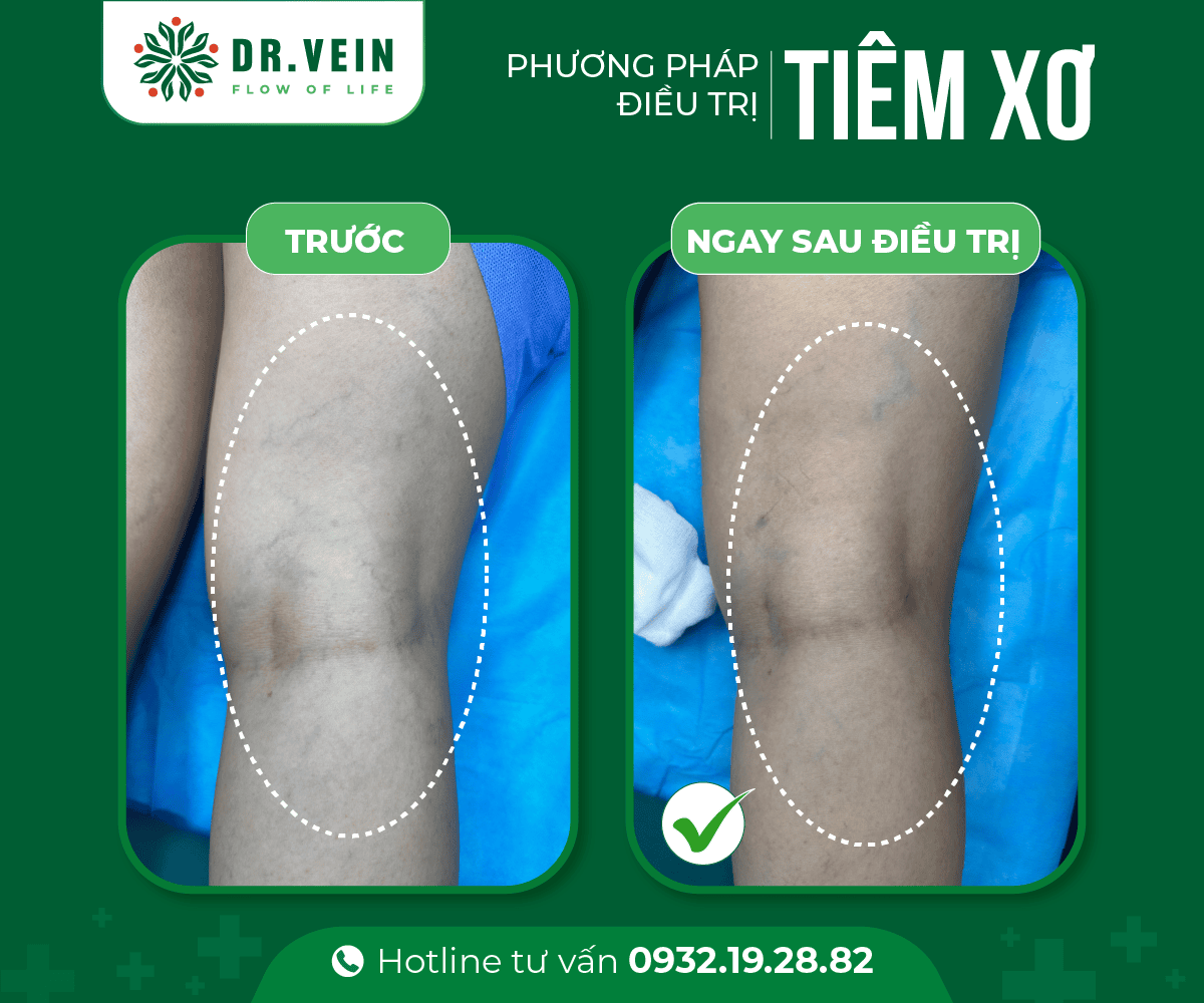 Phương pháp tiêm xơ - Hình ảnh trước & ngay sau điều trị 