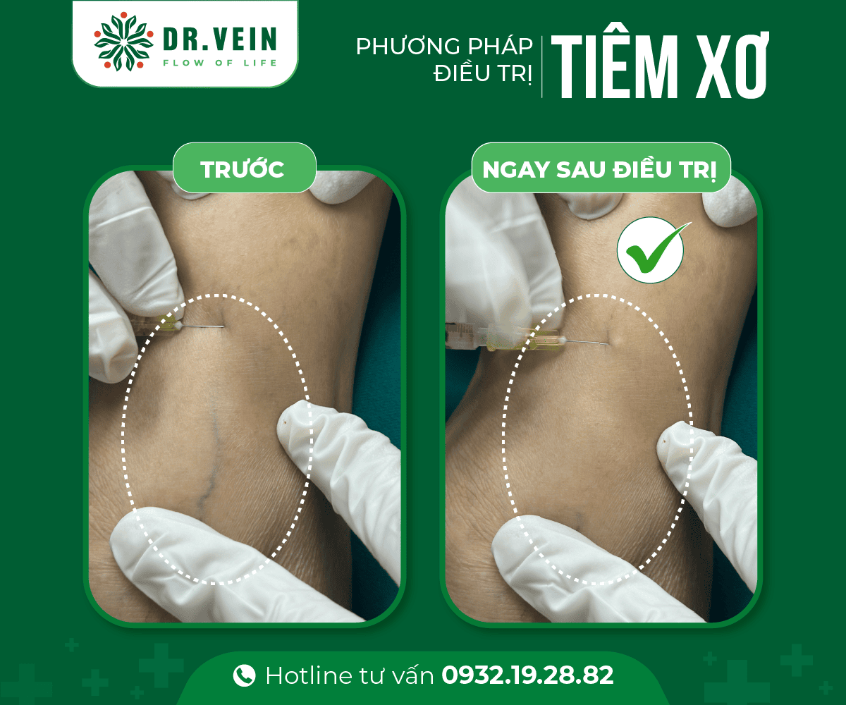 Phương pháp tiêm xơ - Hình ảnh trước & ngay sau điều trị 