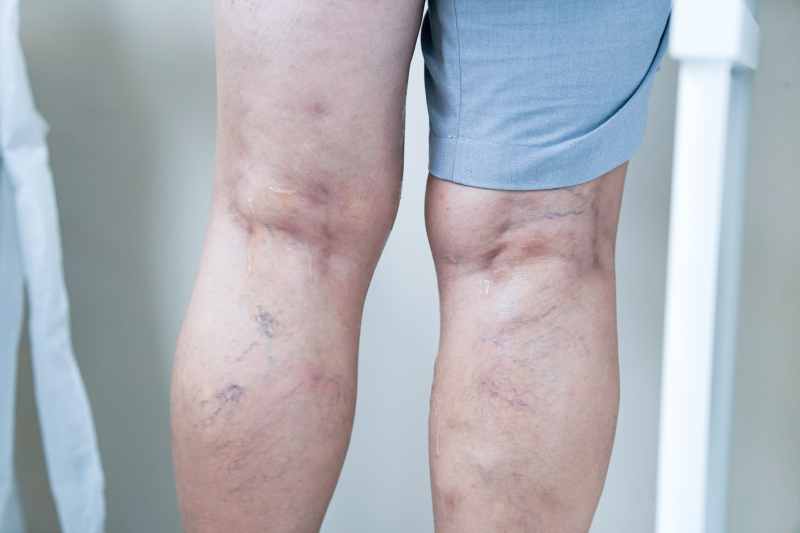 Suy giãn tĩnh mạch C1: Chân nhức nhiều kèm nổi gân xanh 