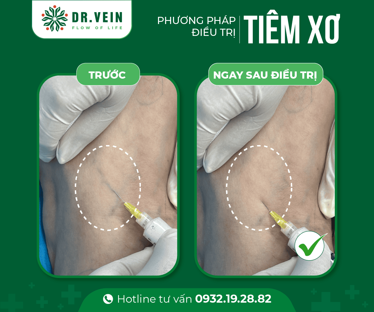 Hiệu quả tiêm xơ bổ sung trong điều trị gân xanh mạng nhện tiem-xo-bo-sung