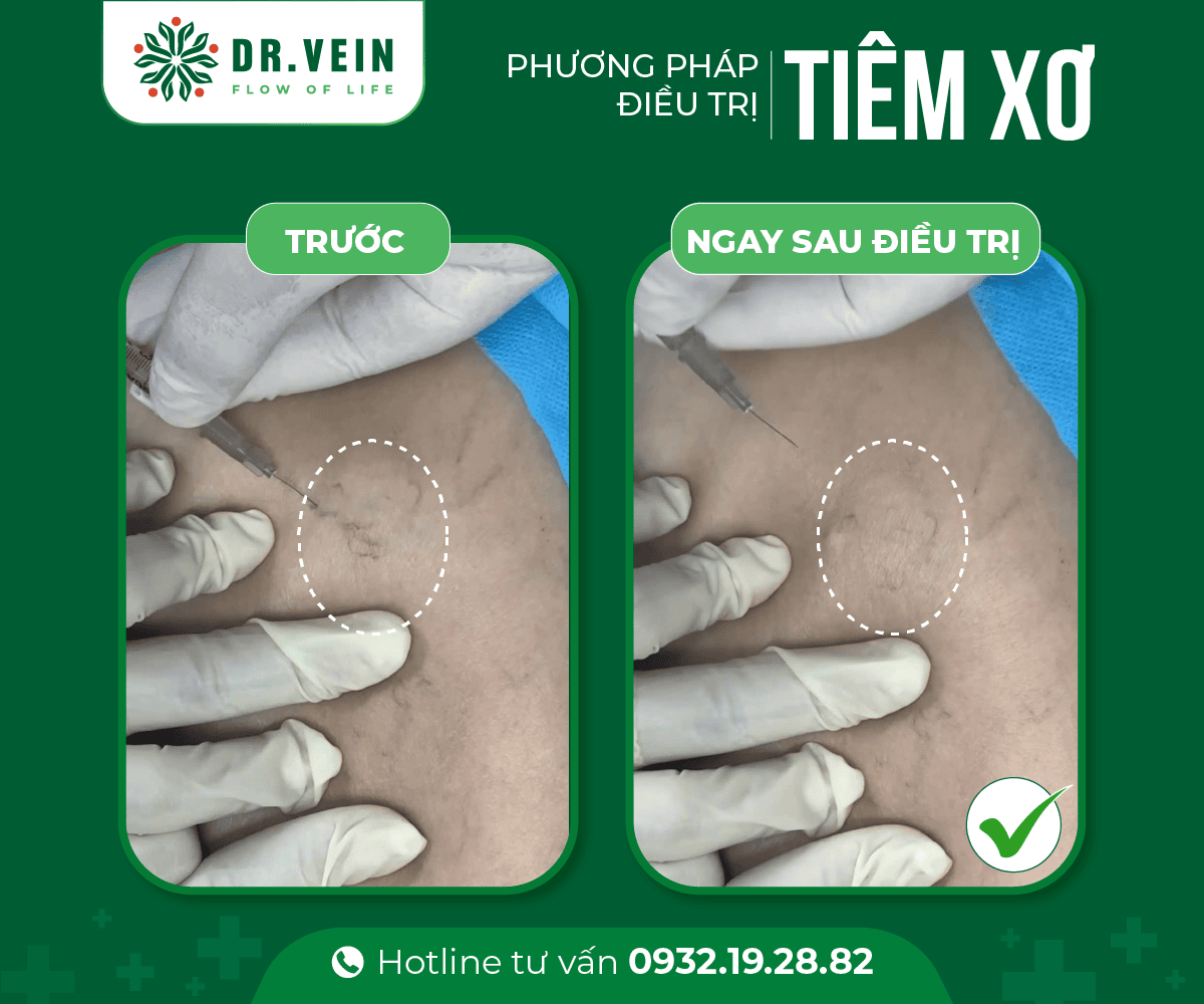 Hiệu quả tiêm xơ bổ sung trong điều trị gân xanh mạng nhện tiem-xo-bo-sung-NNTS-01