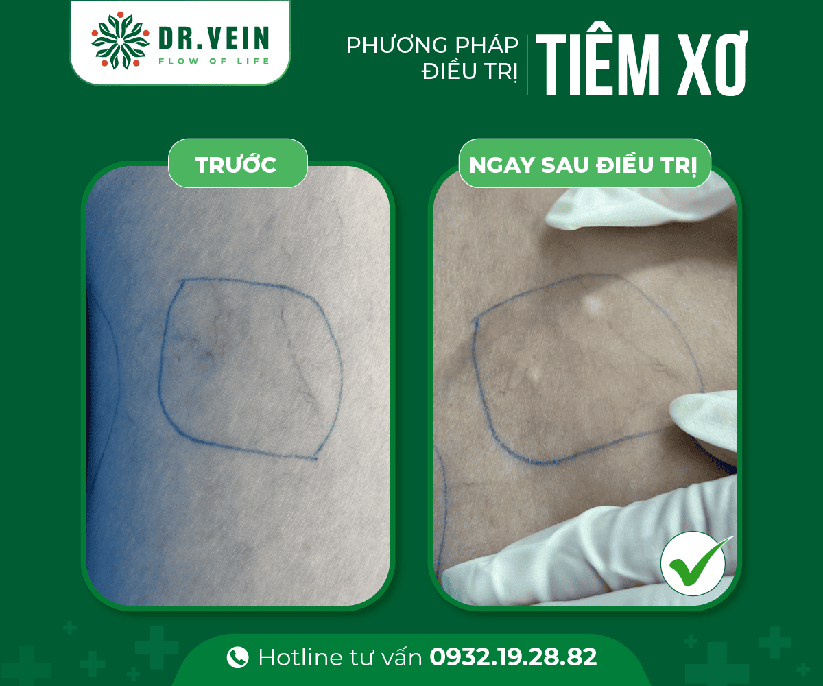 Hiệu quả tiêm xơ bổ sung trong điều trị gân xanh mạng nhện tiem-xo-bo-sung-NNTS-02