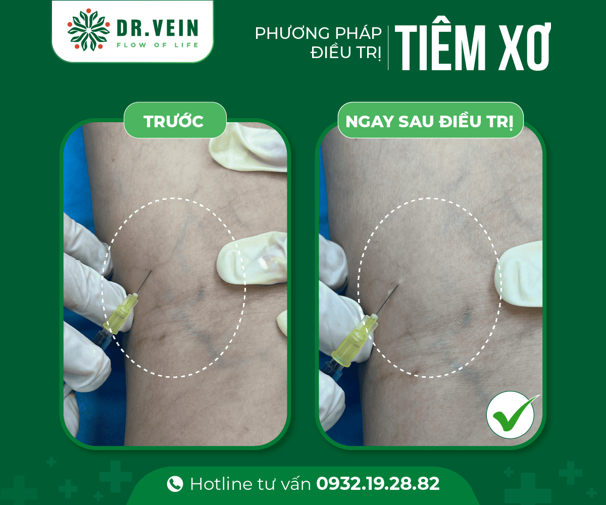 Hiệu quả tiêm xơ bổ sung trong điều trị gân xanh mạng nhện tiem-xo-bo-sung-NNTS-03