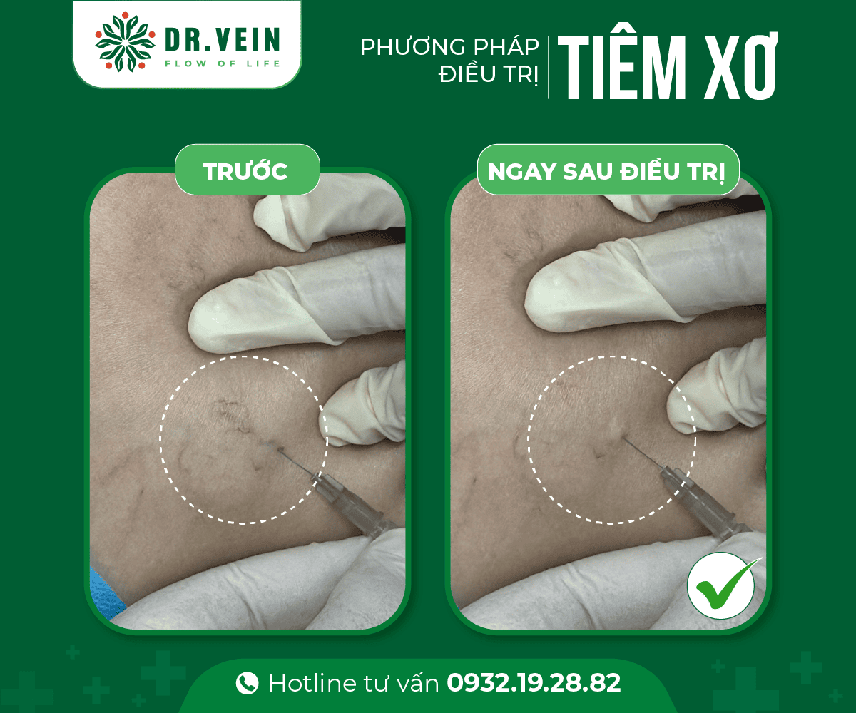 Hiệu quả tiêm xơ bổ sung trong điều trị gân xanh mạng nhện tiem-xo-bo-sung-NNTS-04