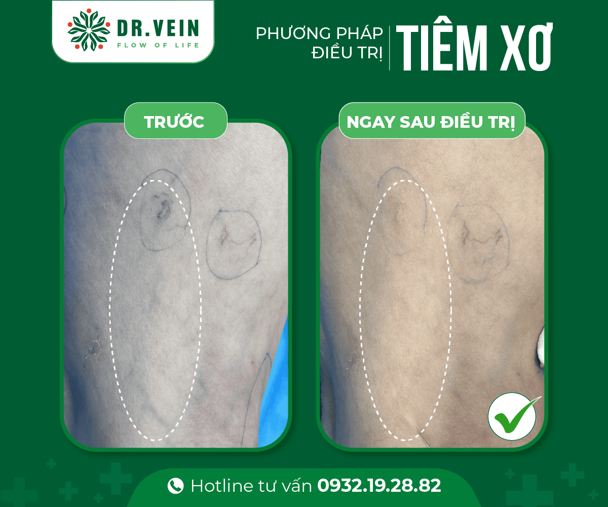 Hiệu quả tiêm xơ bổ sung trong điều trị gân xanh mạng nhện tiem-xo-bo-sung-NNTS-05