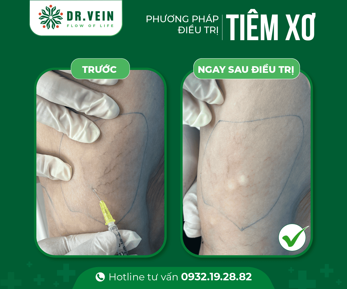 Hiệu quả tiêm xơ bổ sung trong điều trị gân xanh mạng nhện tiem-xo-bo-sung-NNTS-06