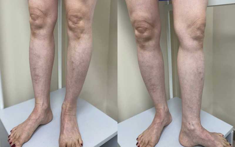 Suy giãn tĩnh mạch C1: Chân nhức nhiều kèm nổi gân xanh 