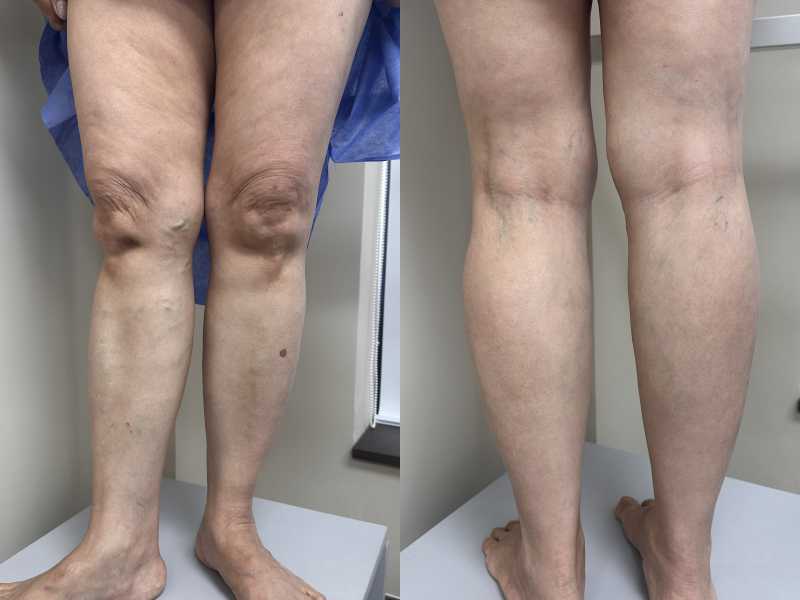 Suy van tĩnh mạch hiển lớn độ 2: Chỉ định can thiệp nội mạch Suy van tĩnh mạch hiển lớn độ 2: Chỉ định can thiệp nội mạch