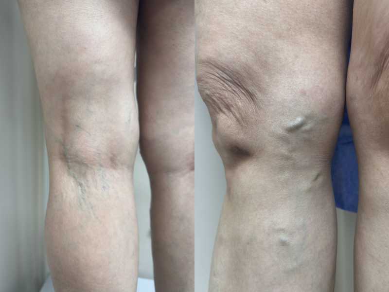 Suy van tĩnh mạch hiển lớn độ 2: Chỉ định can thiệp nội mạch Suy van tĩnh mạch hiển lớn độ 2: Chỉ định can thiệp nội mạch