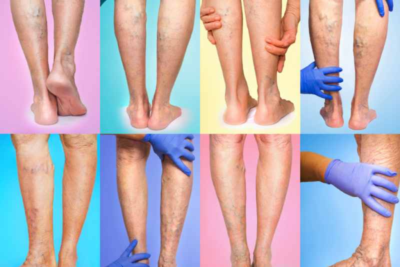 Triệu chứng thực thể trong giai đoạn suy giãn tĩnh mạch?