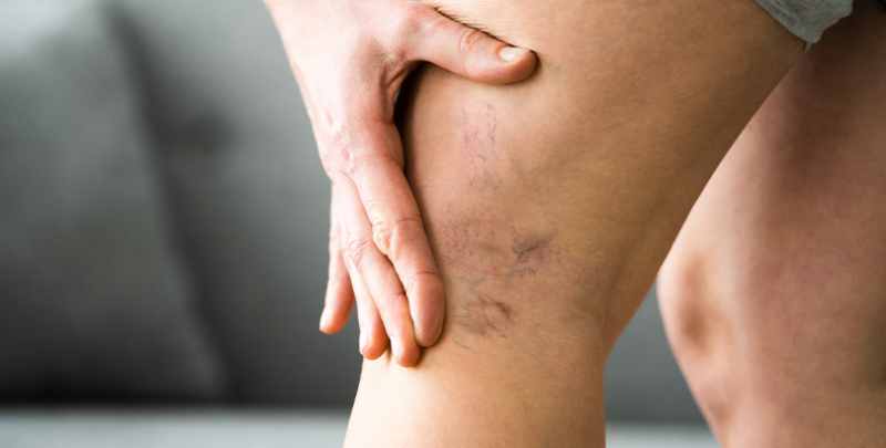 Triệu chứng thực thể trong giai đoạn suy giãn tĩnh mạch?