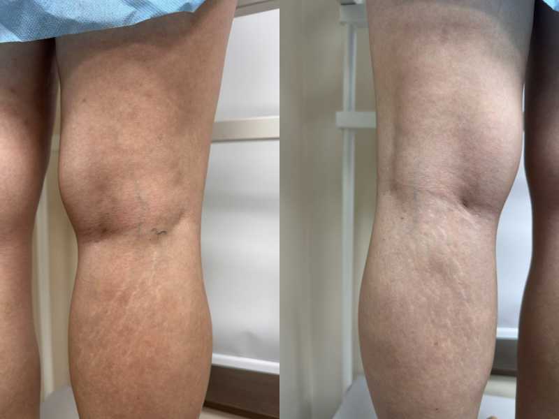 Triệu chứng thực thể trong giai đoạn suy giãn tĩnh mạch?