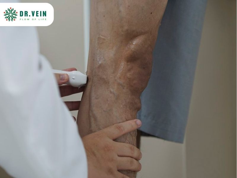 Điều trị suy van tĩnh mạch hiển lớn bằng tiêm xơ UGFS có hiệu quả không?