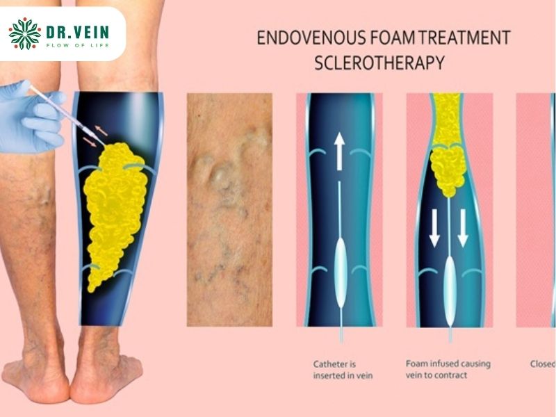 Điều trị suy van tĩnh mạch hiển lớn bằng tiêm xơ UGFS có hiệu quả không?