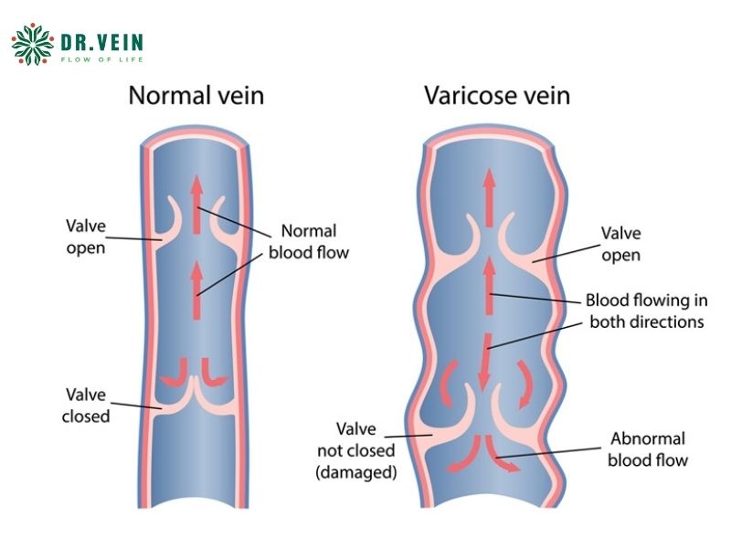 Phác đồ điều trị suy van tĩnh mạch chi dưới cho người trẻ tuổi Phác đồ điều trị suy van tĩnh mạch chi dưới cho người trẻ tuổi
