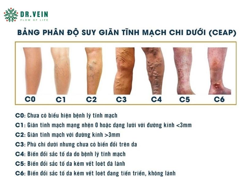 Phác đồ điều trị suy van tĩnh mạch chi dưới cho người trẻ tuổi Phác đồ điều trị suy van tĩnh mạch chi dưới cho người trẻ tuổi