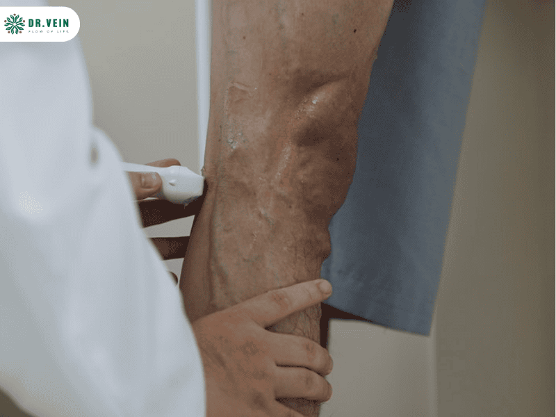 Chân nổi gân xanh có chữa được không? Hiểu đúng để điều trị từ gốc