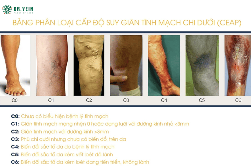 Nhận biết các giai đoạn suy giãn tĩnh mạch qua phân loại CEAP  