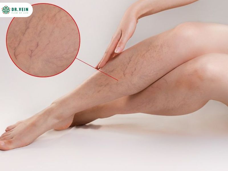 Khi nào cần thực hiện siêu âm tĩnh mạch chi dưới đạt hiệu quả tốt nhất Đối tượng được thực hiện siêu âm tĩnh mạch chi dưới