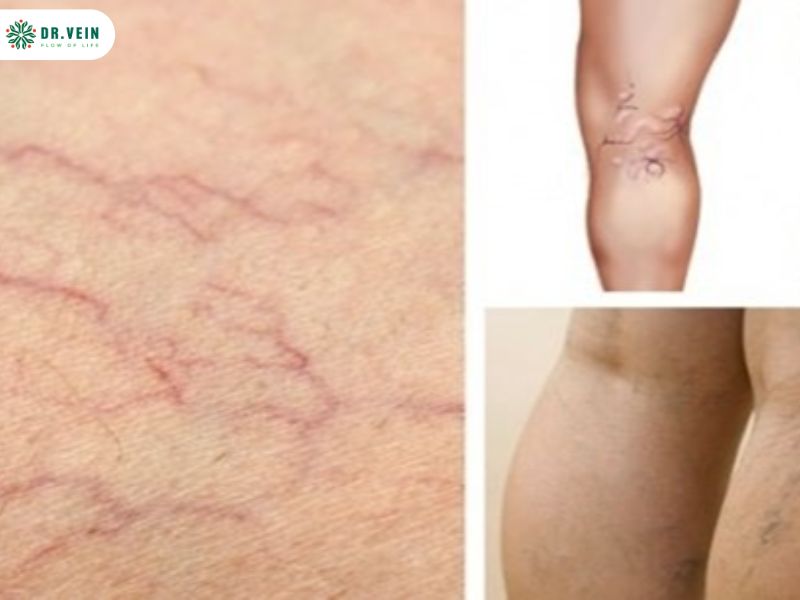 Cần đặc biệt lưu ý và tuân thủ theo hướng dẫn - tiêm xơ tĩnh mạch có nguy hiểm không