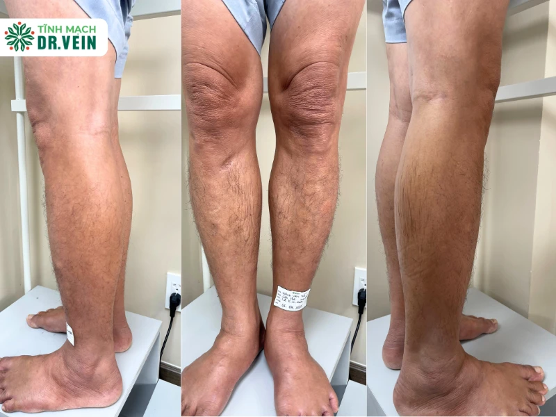 Điều trị suy giãn tĩnh mạch hai chân: Giải pháp cho tình trạng sưng phù, nặng mỏi kéo dài