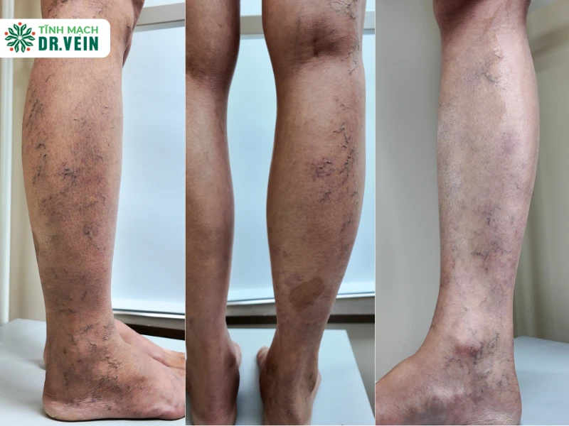 Nhận biết các dấu hiệu giãn tĩnh mạch