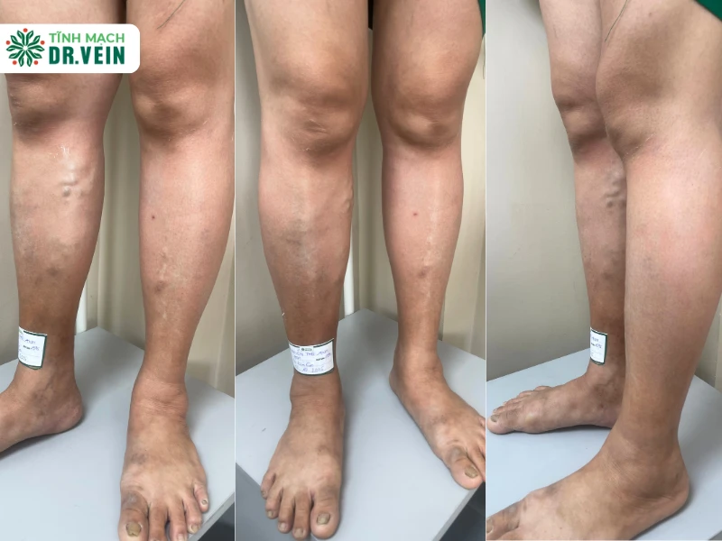 Hơn 10 Năm Sống Chung Với Suy Tĩnh Mạch Chi Dưới – Khi Điều Trị Đúng Mang Lại Hy Vọng Chẩn đoán chính xác: Khi bệnh đã ở giai đoạn nặng