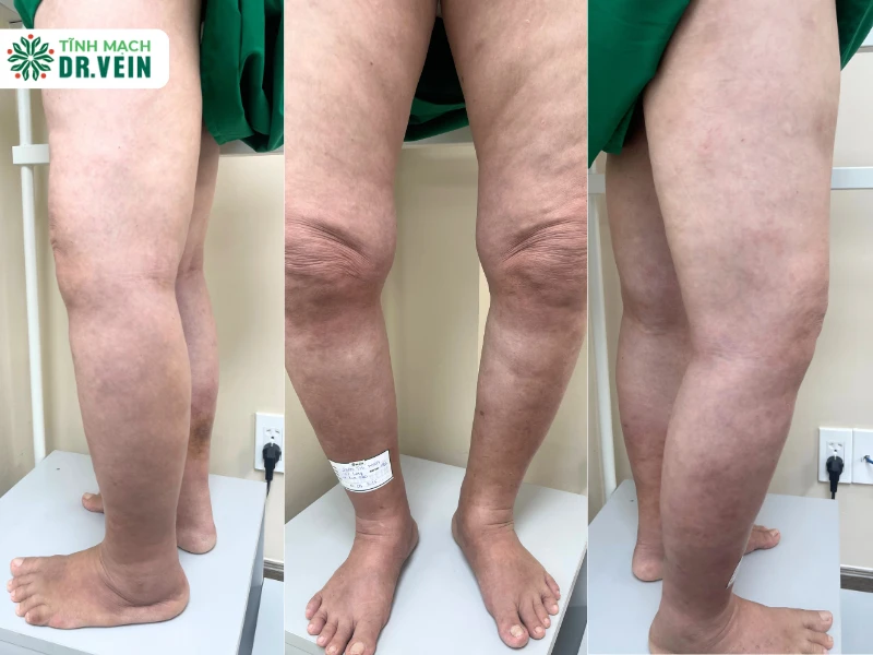 Suy giãn tĩnh mạch chi dưới ở người có nhiều bệnh nền – Khi điều trị đúng giúp đôi chân nhẹ trở lại Thăm khám và chẩn đoán bằng siêu âm Doppler