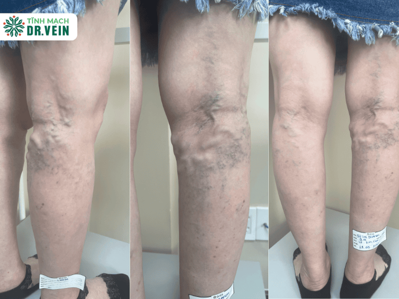 Tình trạng ban đầu – Khi búi tĩnh mạch ngày càng to và lan rộng