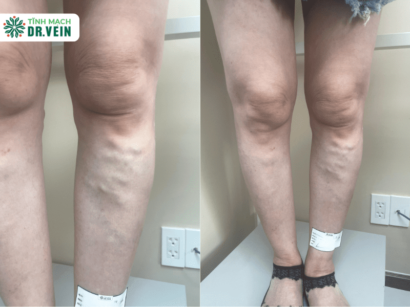 Chẩn đoán chuyên sâu – Xác định mức độ suy van nghiêm trọng