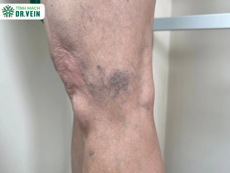 Suy giãn tĩnh mạch mạng nhện có nguy hiểm không?