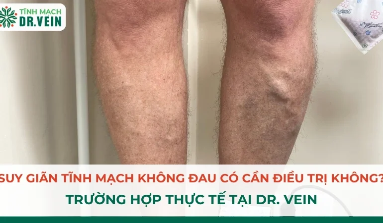 Suy Giãn Tĩnh Mạch Không Đau Có Cần Điều Trị Không? Trường Hợp Thực Tế Suy Giãn Tĩnh Mạch Không Đau Có Cần Điều Trị Không? Trường Hợp Thực Tế