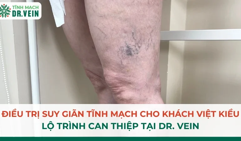 Điều Trị Suy Giãn Tĩnh Mạch Cho Khách Việt Kiều: Lộ Trình Can Thiệp Tại Dr. Vein Điều Trị Suy Giãn Tĩnh Mạch Cho Khách Việt Kiều: Lộ Trình Can Thiệp Tại Dr. Vein
