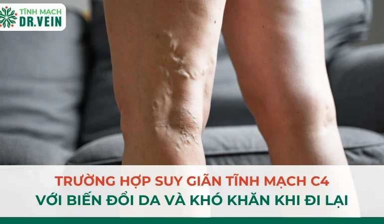 Suy Giãn Tĩnh Mạch C4 Với Biến Đổi Da Và Đi Lại Khó Khăn