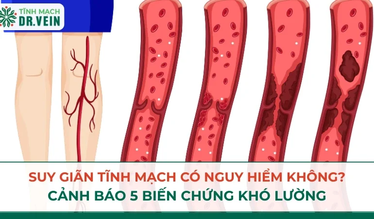 Suy Giãn Tĩnh Mạch Có Nguy Hiểm Không? Cảnh Báo 5 Biến Chứng Khó Lường