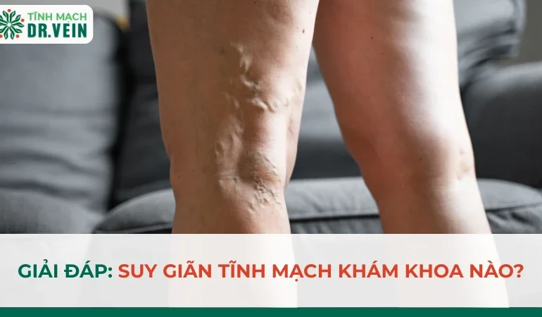 Giải Đáp: Suy Giãn Tĩnh Mạch Khám Khoa Nào?