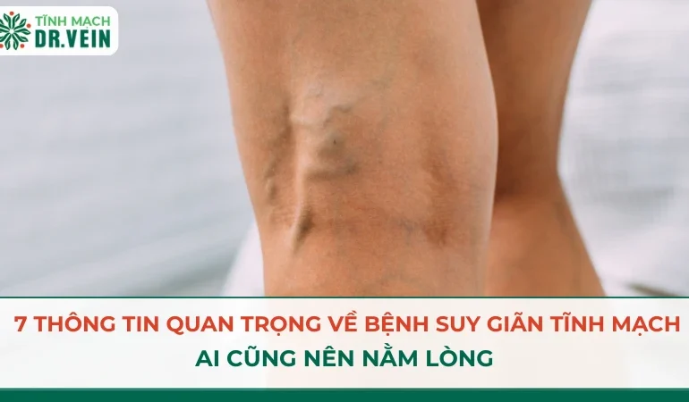 7 Thông Tin Quan Trọng Về Bệnh Suy Giãn Tĩnh Mạch Ai Cũng Nên Nằm Lòng