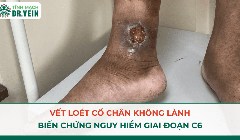 Vết Loét Cổ Chân Không Lành: Biến Chứng Nguy Hiểm Giai Đoạn C6
