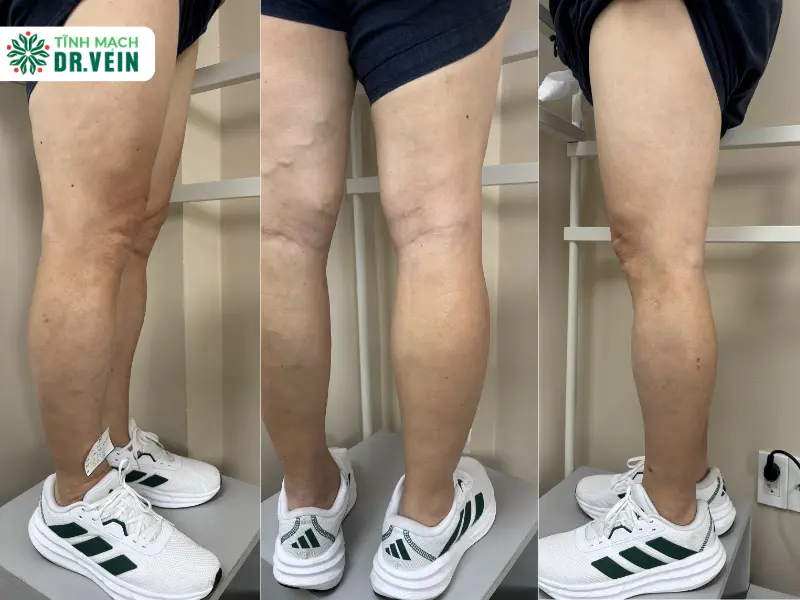 Phác Đồ Điều Trị Phối Hợp Ngăn Ngừa Biến Chứng