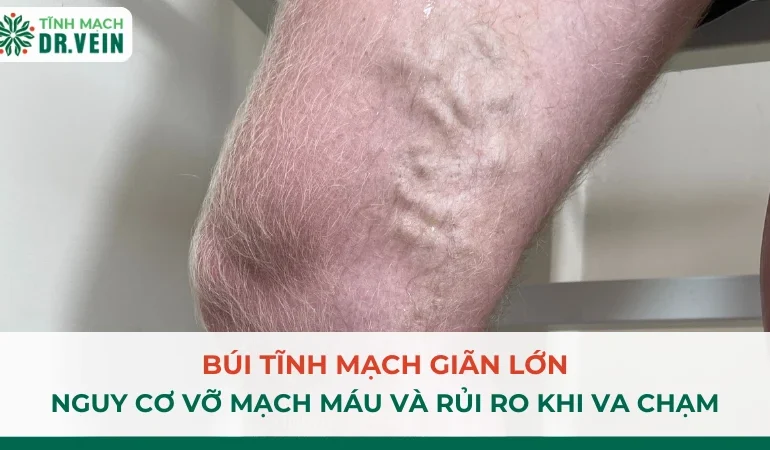 Búi Tĩnh Mạch Giãn Lớn: Nguy Cơ Vỡ Mạch Và Rủi Ro Khi Va Chạm