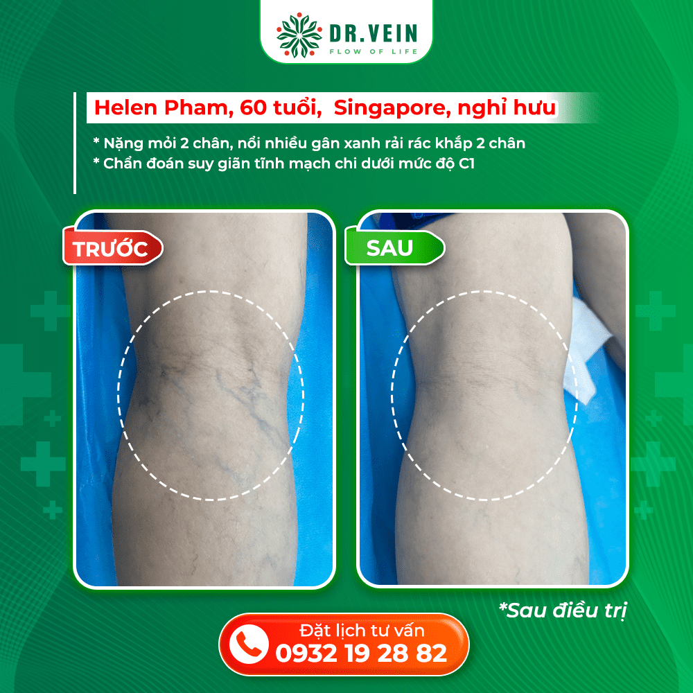 Điều Trị Suy Giãn Tĩnh Mạch Sớm: Bí Quyết Giúp Đôi Chân Khỏe Mạnh Ở Tuổi 60 Điều Trị Suy Giãn Tĩnh Mạch Sớm: Bí Quyết Giúp Đôi Chân Khỏe Mạnh Ở Tuổi 60