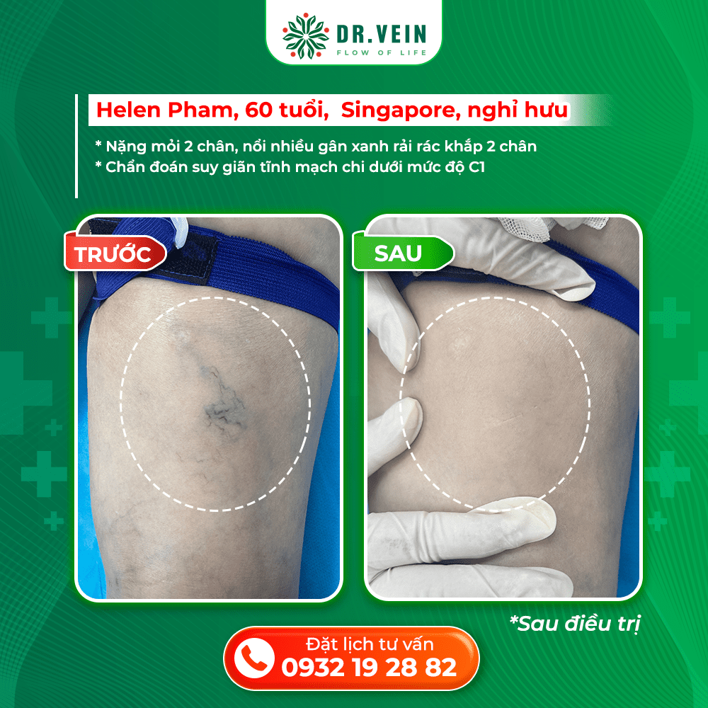 Điều Trị Suy Giãn Tĩnh Mạch Sớm: Bí Quyết Giúp Đôi Chân Khỏe Mạnh Ở Tuổi 60 Helen Pham 3