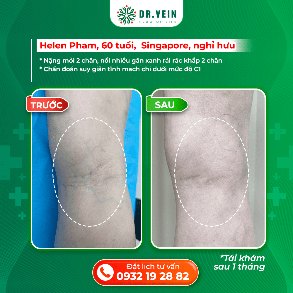 Điều Trị Suy Giãn Tĩnh Mạch Sớm: Bí Quyết Giúp Đôi Chân Khỏe Mạnh Ở Tuổi 60 Điều Trị Suy Giãn Tĩnh Mạch Sớm: Bí Quyết Giúp Đôi Chân Khỏe Mạnh Ở Tuổi 60