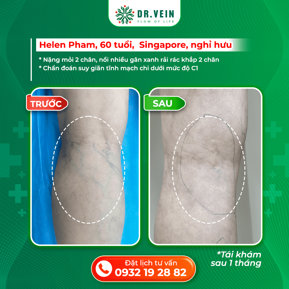Điều Trị Suy Giãn Tĩnh Mạch Sớm: Bí Quyết Giúp Đôi Chân Khỏe Mạnh Ở Tuổi 60 Điều Trị Suy Giãn Tĩnh Mạch Sớm: Bí Quyết Giúp Đôi Chân Khỏe Mạnh Ở Tuổi 60