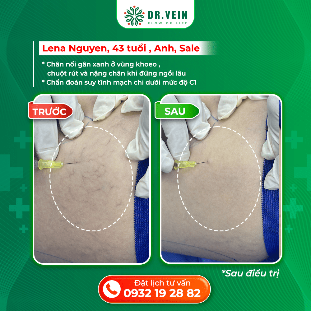 Xử Lý Nặng Chân Khi Ngồi Lâu Và Gân Xanh Vùng Khoeo Cho Bệnh Nhân C1 Tại Anh Xử Lý Nặng Chân Khi Ngồi Lâu Và Gân Xanh Vùng Khoeo Cho Bệnh Nhân C1 Tại Anh