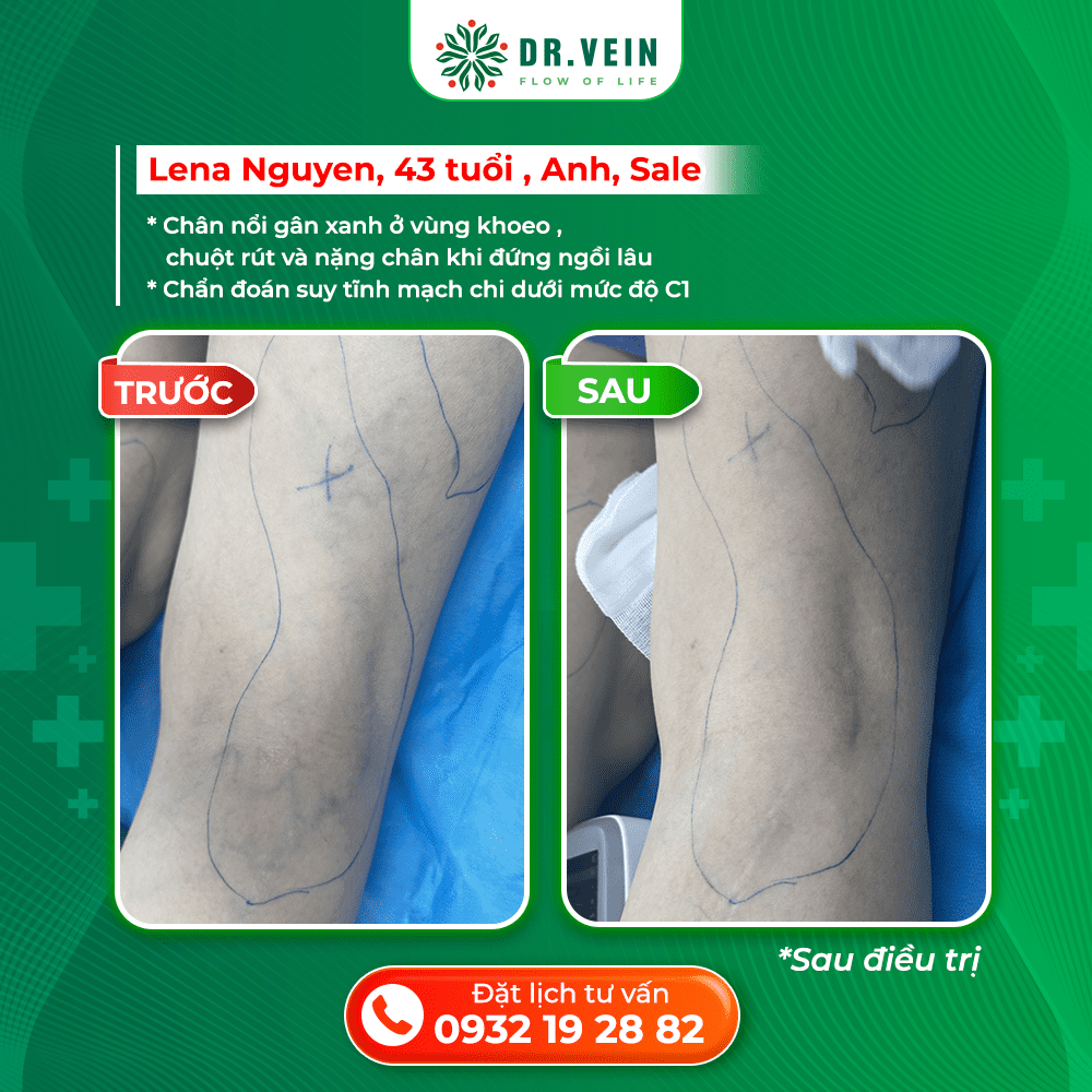 Xử Lý Nặng Chân Khi Ngồi Lâu Và Gân Xanh Vùng Khoeo Cho Bệnh Nhân C1 Tại Anh Xử Lý Nặng Chân Khi Ngồi Lâu Và Gân Xanh Vùng Khoeo Cho Bệnh Nhân C1 Tại Anh