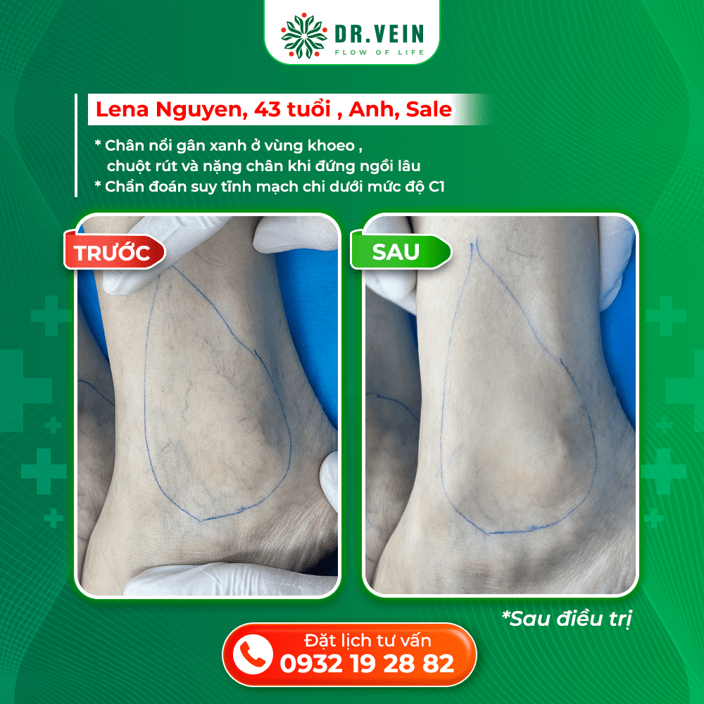 Xử Lý Nặng Chân Khi Ngồi Lâu Và Gân Xanh Vùng Khoeo Cho Bệnh Nhân C1 Tại Anh Xử Lý Nặng Chân Khi Ngồi Lâu Và Gân Xanh Vùng Khoeo Cho Bệnh Nhân C1 Tại Anh
