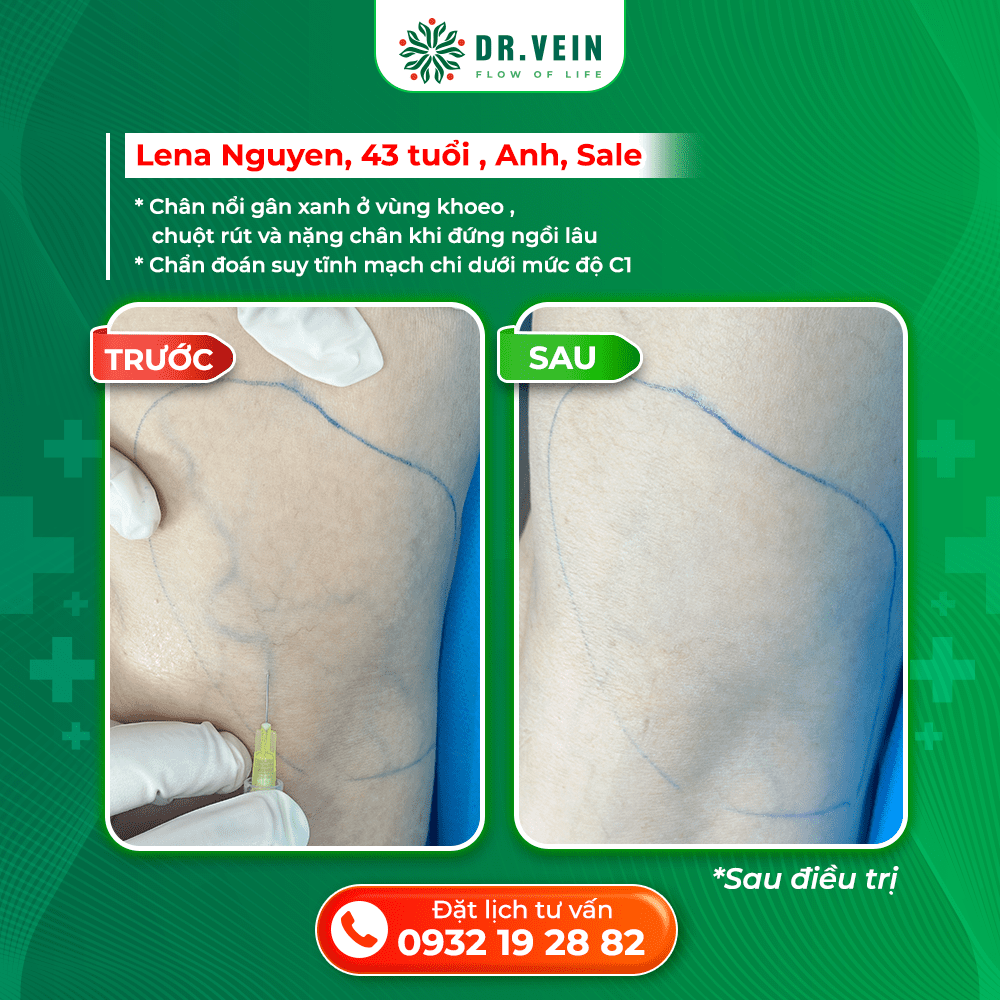 Xử Lý Nặng Chân Khi Ngồi Lâu Và Gân Xanh Vùng Khoeo Cho Bệnh Nhân C1 Tại Anh Xử Lý Nặng Chân Khi Ngồi Lâu Và Gân Xanh Vùng Khoeo Cho Bệnh Nhân C1 Tại Anh