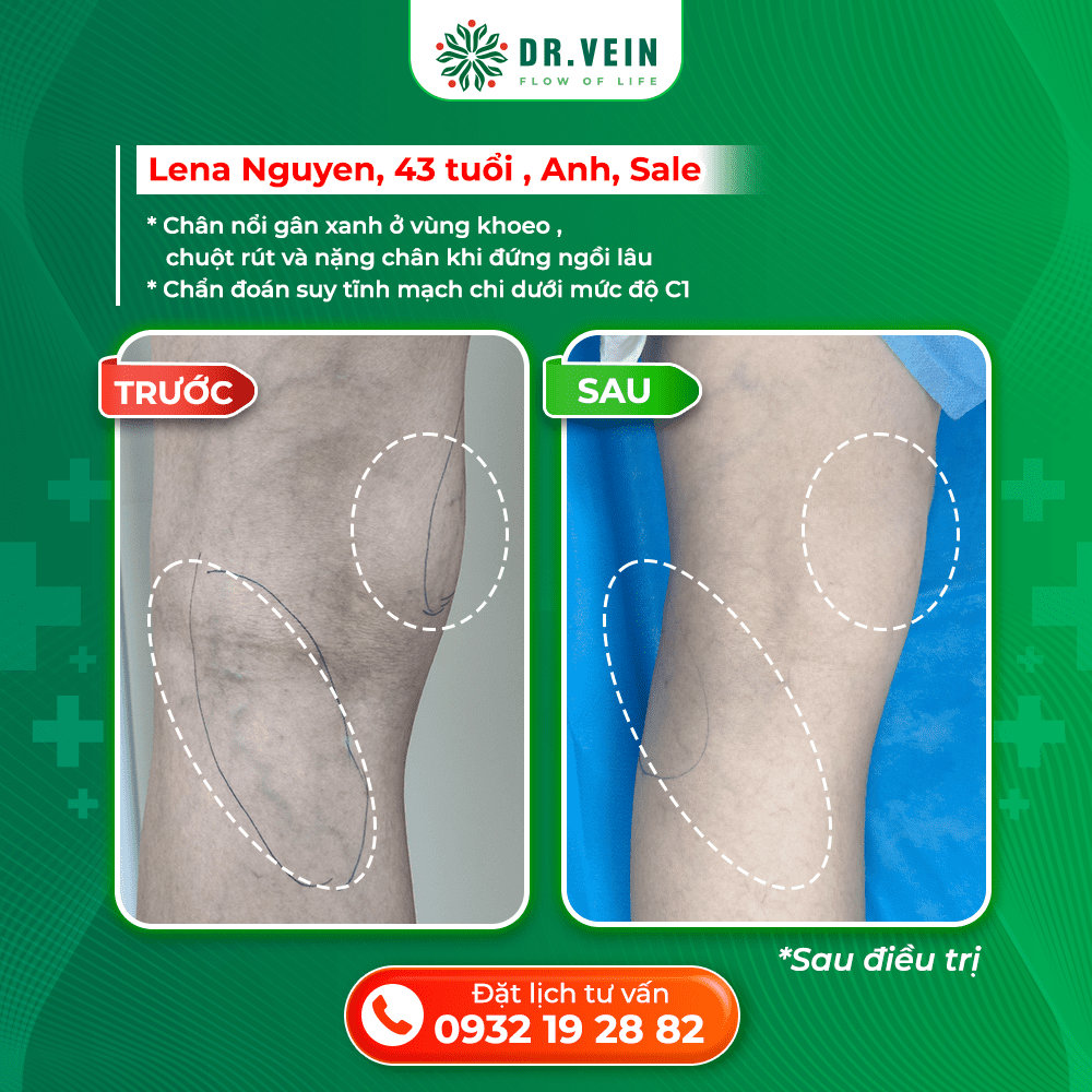 Xử Lý Nặng Chân Khi Ngồi Lâu Và Gân Xanh Vùng Khoeo Cho Bệnh Nhân C1 Tại Anh Xử Lý Nặng Chân Khi Ngồi Lâu Và Gân Xanh Vùng Khoeo Cho Bệnh Nhân C1 Tại Anh
