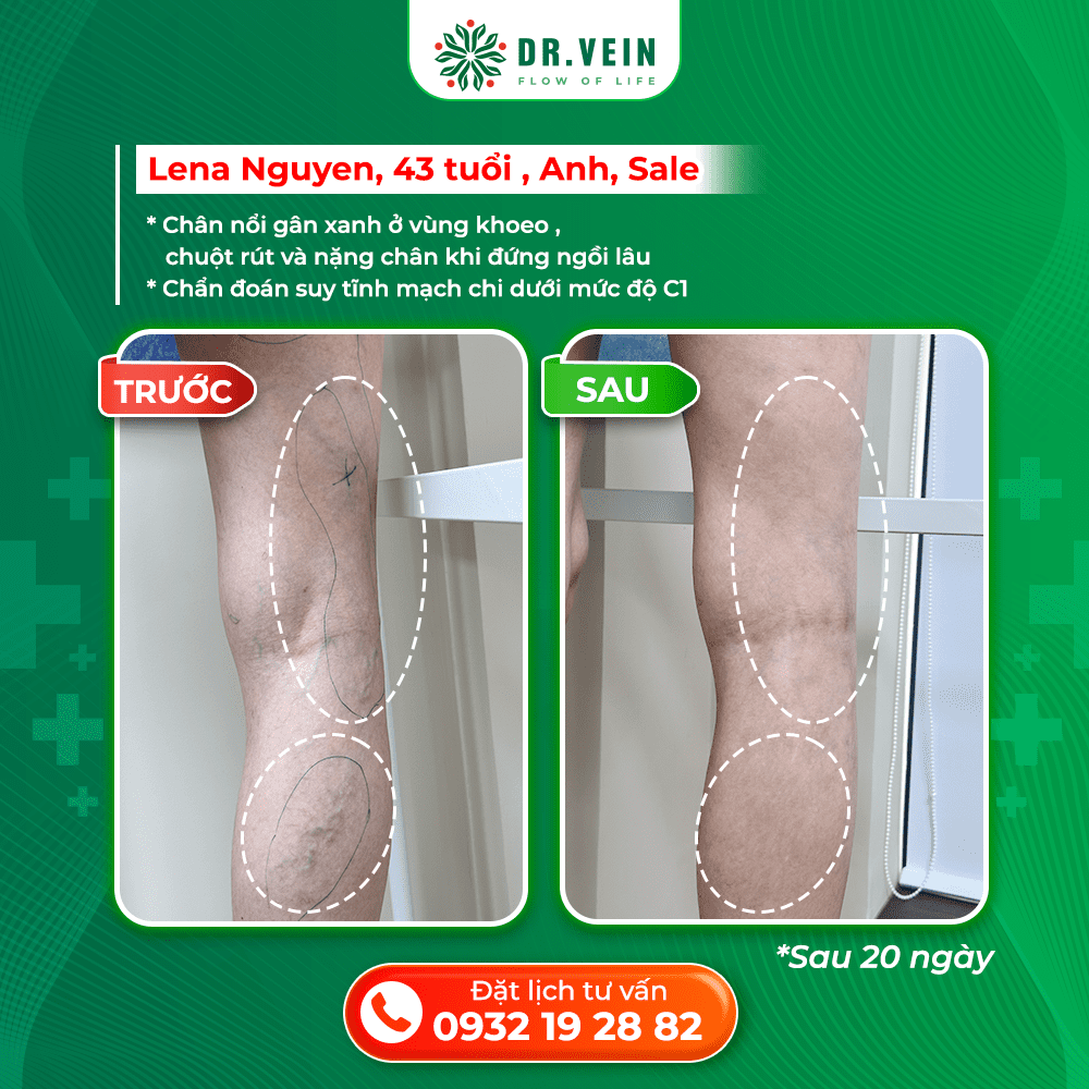 Xử Lý Nặng Chân Khi Ngồi Lâu Và Gân Xanh Vùng Khoeo Cho Bệnh Nhân C1 Tại Anh Xử Lý Nặng Chân Khi Ngồi Lâu Và Gân Xanh Vùng Khoeo Cho Bệnh Nhân C1 Tại Anh
